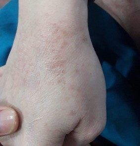 image eczema
