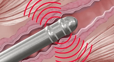 image électrostimulation vaginale revigen